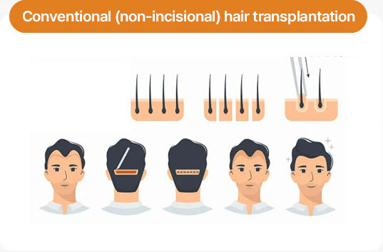 Conventional (non-incisional) hair transplantation