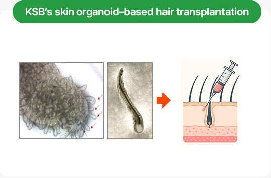 KSB’s skin organoid–based hair transplantation