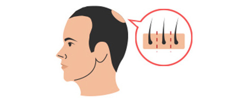 Hair follicle transplantation